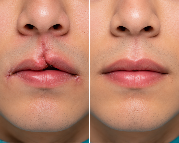 Surgeon consulting a patient about Post-Traumatic Lip Deformity Correction